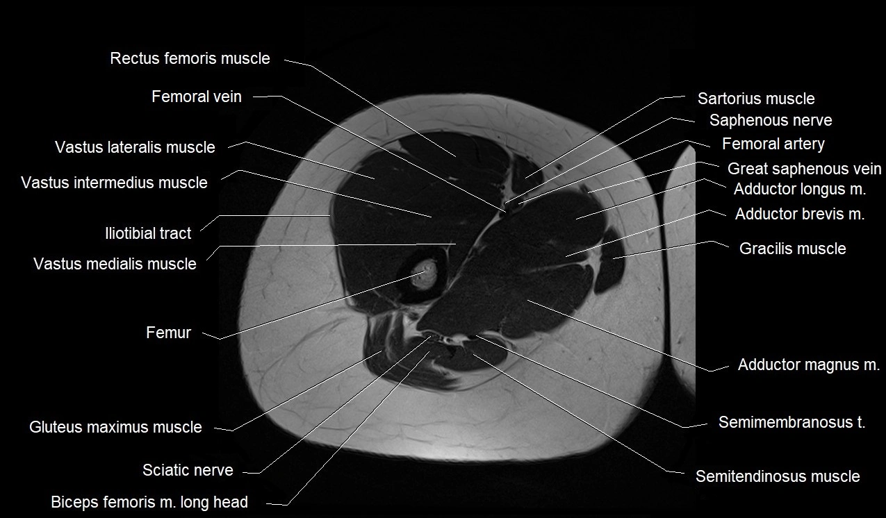 MRI thigh cross sectional anatomy image 21.webp